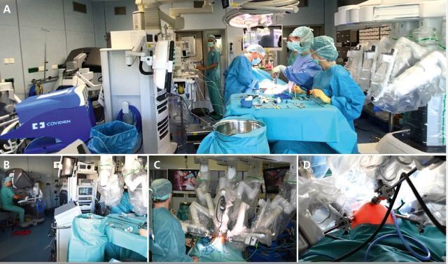 Abb. 1: Räumliches Setup für robotisch assistierte Kinderchirurgie. A–C) Typische Anordnung der Instrumente und des Roboters im kinderchirurgischen Operationssaal. D) Beispiel für die Trokarplazierung bei robotisch assistierter laparoskopischer Harnleiterneueinpflanzung nach Lich-Gregoire.