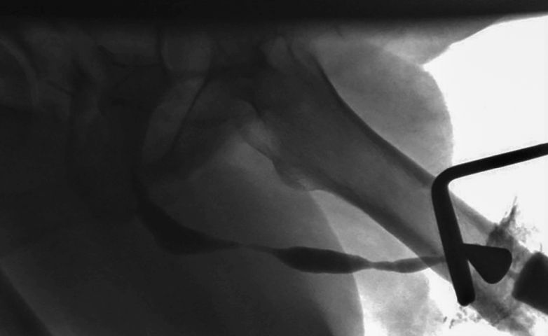 Abb. 2: Das Urethrogramm zeigt eine multilokuläre Striktur der Harnröhre.