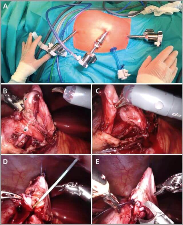 Abb. 2: Robotisch assistierte laparoskopische Pyeloplastik. A) Trokarpositionen. B) Präparation des Ureters; > = Ureter; * = Aberrierendes unteres Polgefäß. C) Spatulieren des Ureters vor der Anastomosierung an das Nierenbecken. D) Beginn der Anastomose und Einlage eines Doppel-J-Katheters in den Ureter bis in die Harnblase. E) Komplettierung der Anastomose.