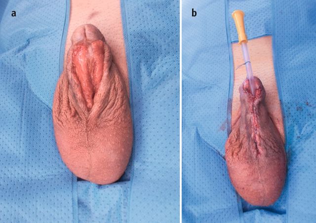 Abb. 3: Deckung der tubularisierten MSH-Platte mit Penisshafthaut (©Archiv von M. Borisenkov).