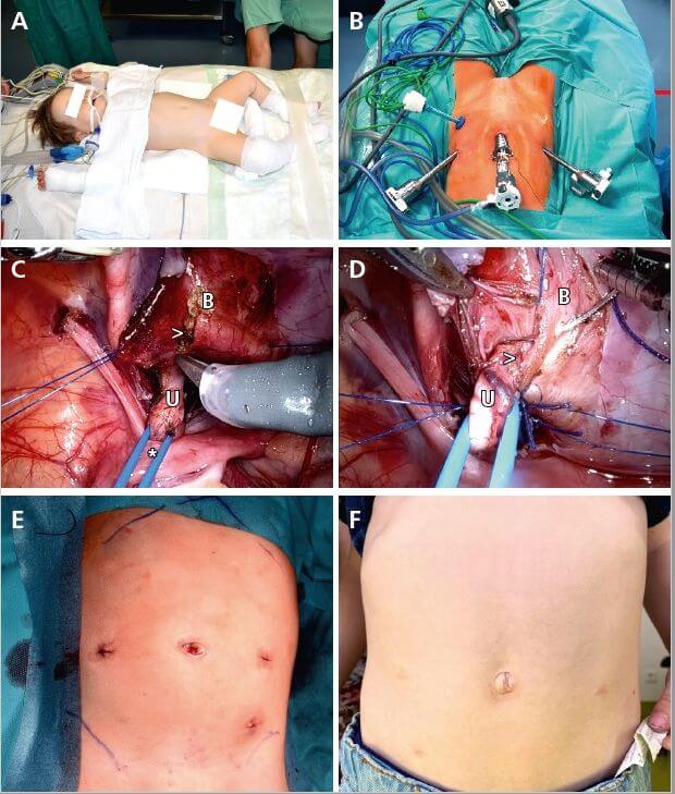 Abb. 3: Robotisch assistierte laparoskopsche Harnleiterneueinpflanzung nach Lich-Gregoire. A) Lagerung der Kinder. B) Trokarpositionen. C) Anschlingen des Ureters mit Vessel Loop, Detrusotomie; U = Ureter; B = Harnblase; * = Vessel Loop; > = Detrusotomie. D) Detrusorrhaphie. E) Postoperative Darstellung der Trokarstellen. F) Nach 3 Monaten.