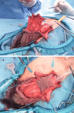 Abb. 4: Deckung der tubularisierten MSH-Platte mit Skrotallappen (© Archiv von M. Borisenkov).