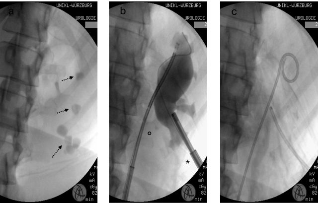 Abb. 3: intraoperative Röntgenbilder: a) Klassische ECIRS-Indikation: ausgedehnte Steinlast in mehrern Endkelchen der linken Niere, die vorauss. nicht mittels alleiniger Mini-PNL saniert werden kann b) ECIRS via flex. URS und mini-PNL* c) steinfreie Niere mit einliegender PCN und Mono-J.