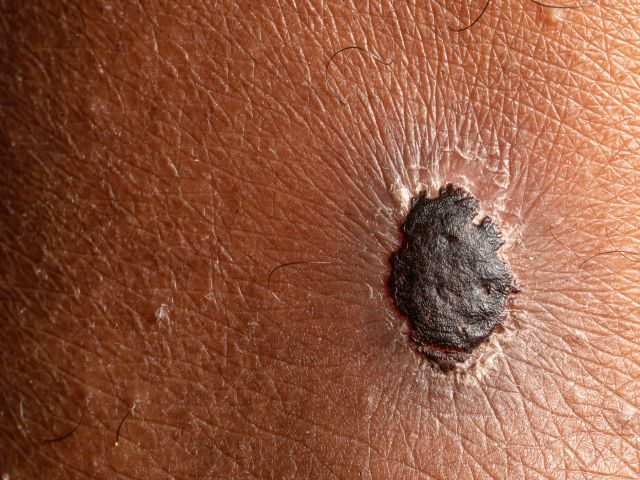 Nahaufnahme eines Melanom-Hautkrebses, der auf der menschlichen Haut wächst