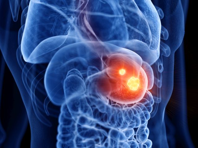 3D-Darstellung einer medizinisch korrekten Darstellung von Magenkrebs