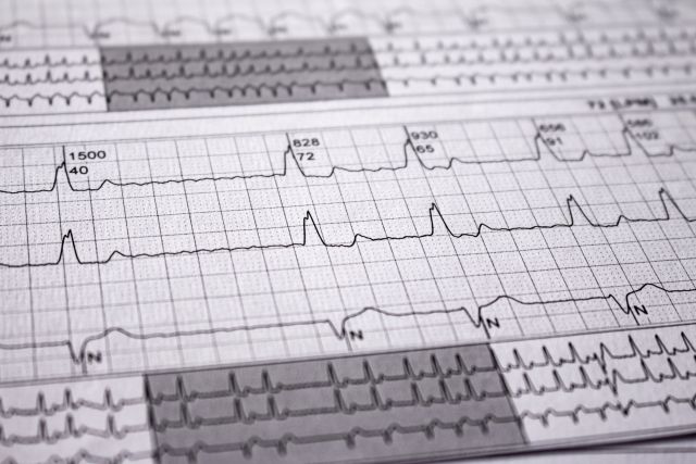 Herzschlag auf Papier dargestellt. Herzrhythmusstörungen. Selektiver Fokus auf einige Schläge. Vorhofflimmern, intraventrikuläre Reizleitungsstörung. Freier Platz zum Schreiben.