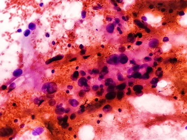 Spindelzellsarkom: ein äußerst seltener Knochenkrebs. Mikrofotografie der Weichteiltumorzytologie.