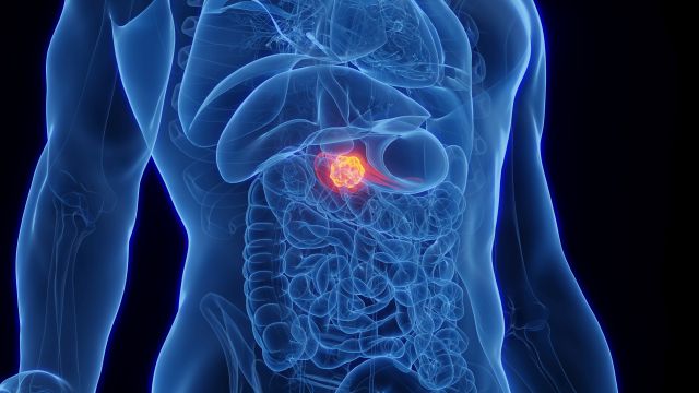 3D-gerenderte medizinische Illustration der männlichen Anatomie – Bauchspeicheldrüsenkrebs.