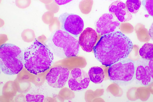 Chronische myeloische Leukämiezellen oder CML, Analyse unter dem Mikroskop