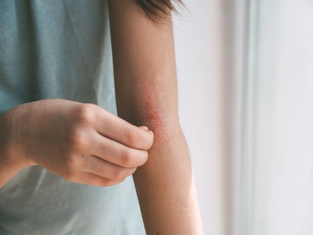 Ein Mädchen kratzt sich die Haut am Ellenbogen ihres Arms, die Rötung ist atopische Dermatitis, das Gesicht des Mädchens ist nicht sichtbar