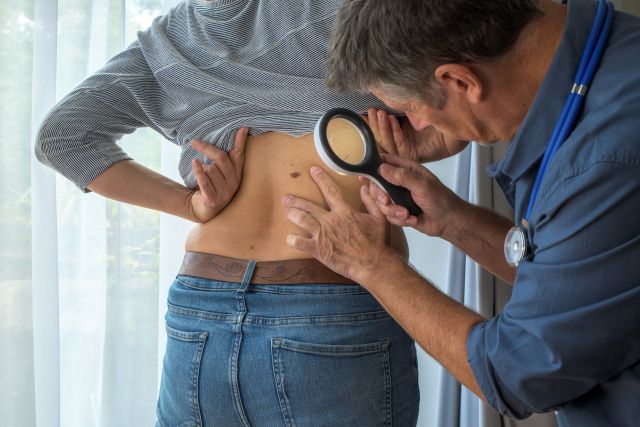 Muttermaluntersuchung, dermatologische Beratung in einer Krankenhausklinik. Der Arzt untersucht die Patientin mit einer Lupe auf krebsartige Muttermale auf ihrer Haut.