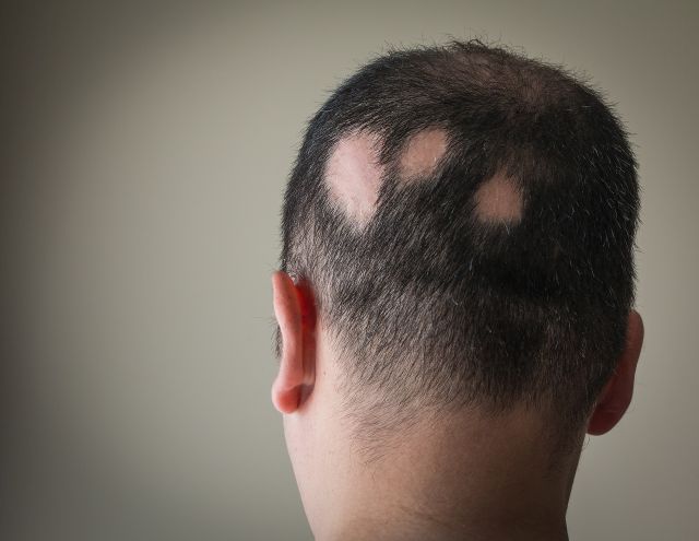 Hinterkopf mit Alopecia