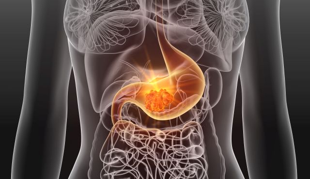 3D-Illustration einer Frau mit Magenkarzinom, für dessen Therapie die MSI von großer Bedeutung ist.