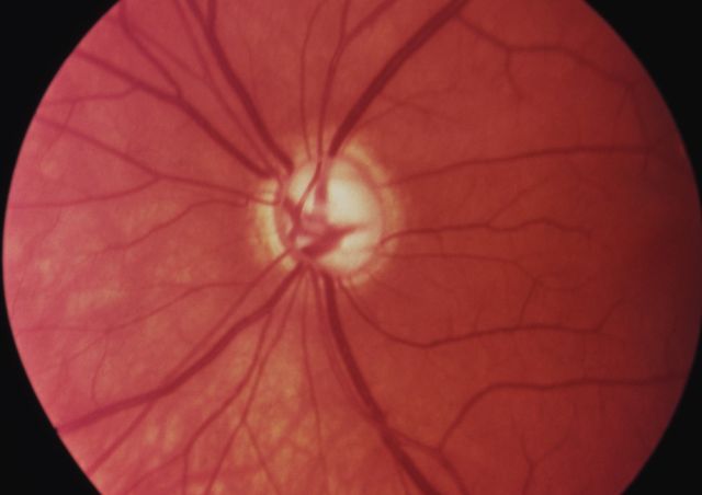 Fundusaufnahme einer Glaukompapille