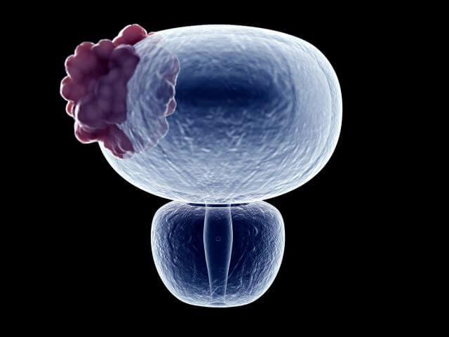 3D-Illustration der Harnblase mit Tumor