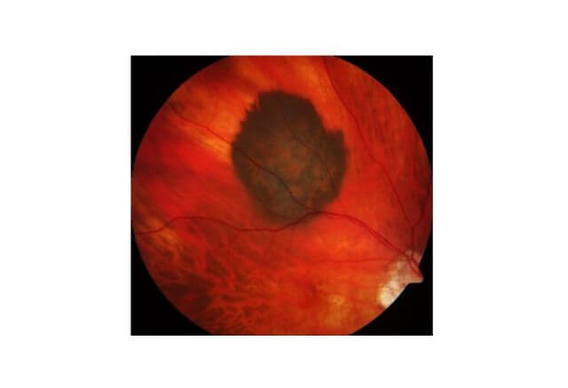 Foto eines Aderhautmelanoms