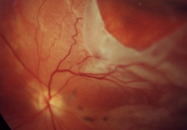 Nahaufnahme einer Netzhautablösung