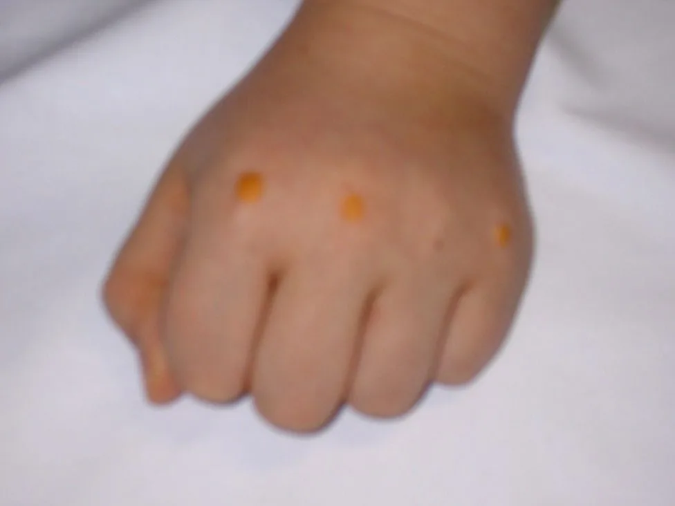 5-jähriges Kind mit heterozygoter Familiärer Hypercholesterinämie