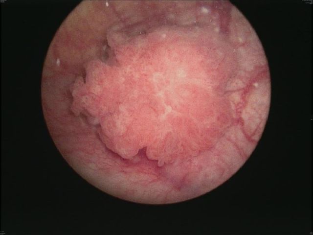 Zytoskopie (Blasenspiegelung) mit endoskopischer Darstellung eines 3 Zentimeter großen Blasentumors. (© Renate Pichler)