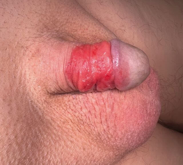 . 1: Großflächiges pT1G2-Peniskarzinom am Penisschaft (präoperativ).