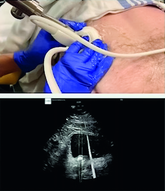 Abb. 2: Therapiekopf zur sonographischen Ortung des Steines, Bewegung des Steines und Desintegration mittels Burst Wave Stoßwelle