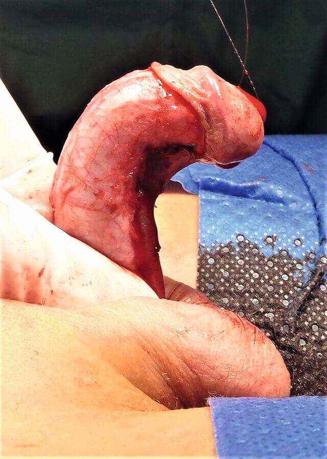 Ausgeprägte Pennisschaftverkrümmung