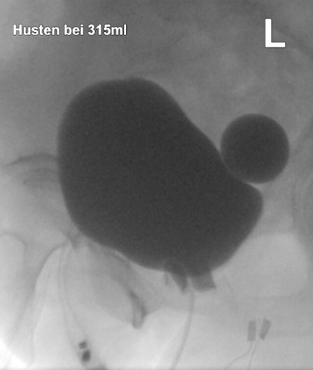 Suffizienter Blasenhalsverschluss