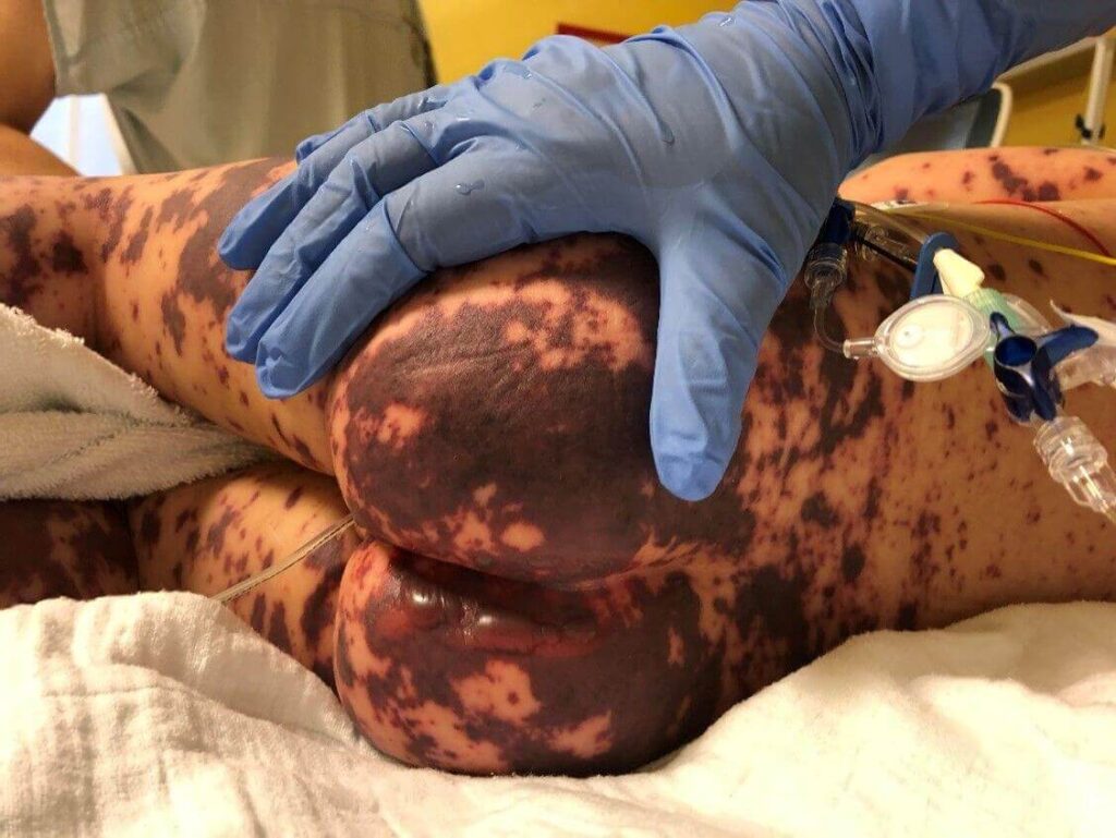 Hautblutungen Gesäß