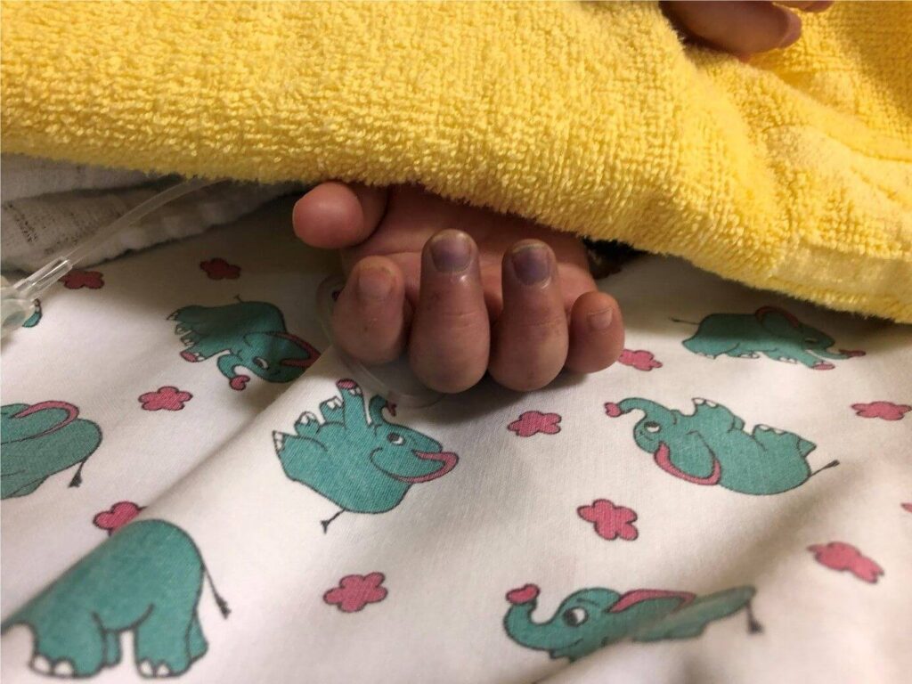 Hautblutungen re. Hand