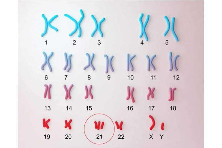 Karyogramm mit farbigen Chromosomenpaaren. Chromosom 21 dreifach vorhanden und rot umkreist.