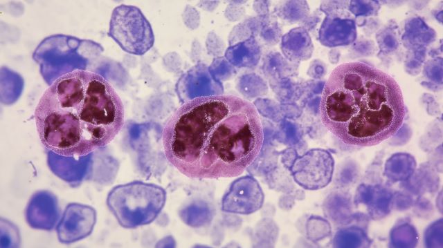 Mikroskopaufnahme von Blutzellen, darunter auffällige Zellen, die auf Leukämie hinweisen könnten.
