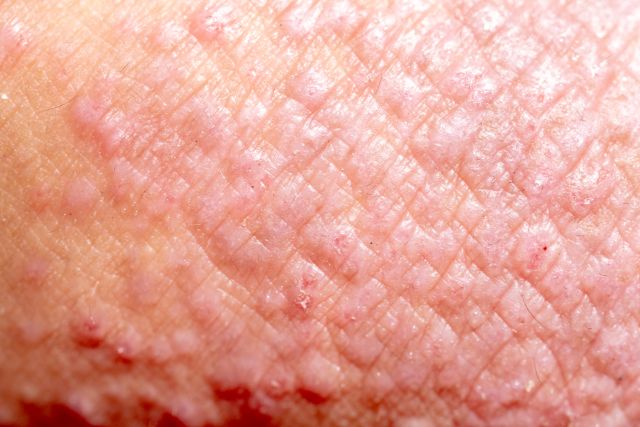 Atopische Dermatitis (AD), auch als atopisches Ekzem bekannt, ist eine Art Entzündung der Haut (Dermatitis).