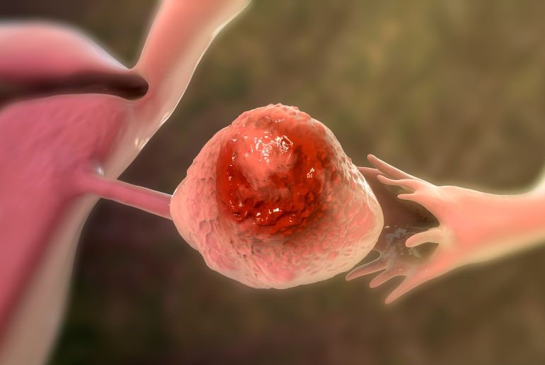 3D-Visualisierung eines Ovarialkarzinoms: roter Tumor inmitten von rosafarbenem Eierstockgewebe.