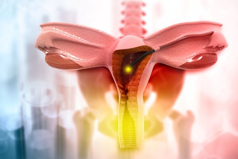 Modell zur Veranschaulichung einer Hysteroskopie: Beleuchtete Gebärmutter im Querschnitt.