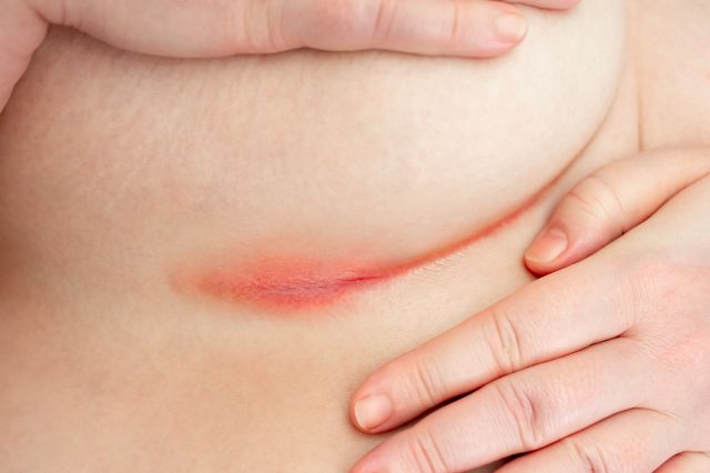 Bei einer Patientin mit Intertrigo tritt ein erythematöser Ausschlag in den Hautfalten auf. Hautreizung unter der Brust mit Rötung. Corynebacterium minutissimum