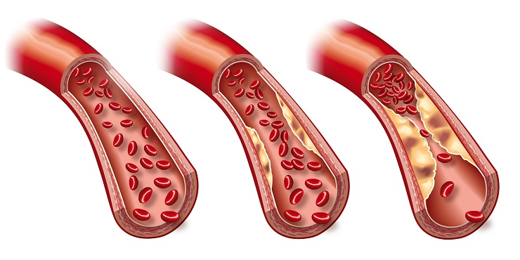 Fetteinschlüsse und Ablagerungen in den Arterien