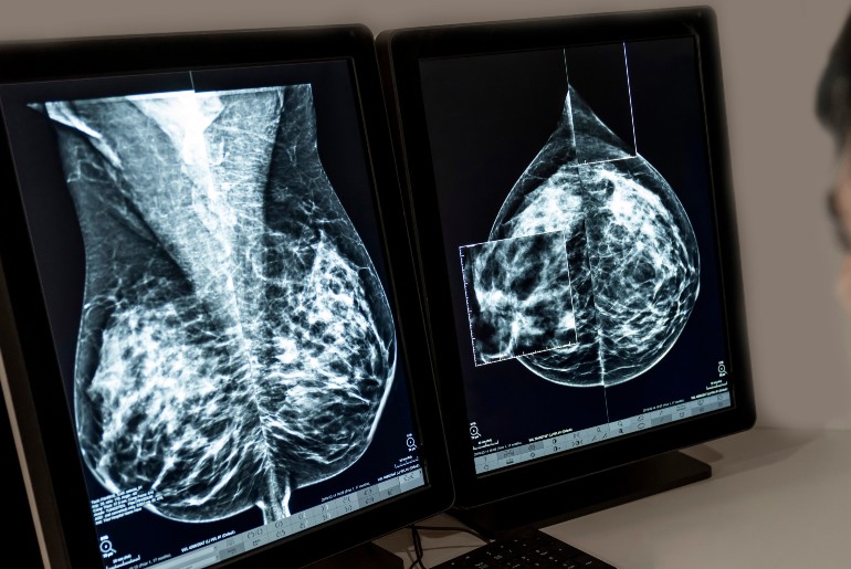 Mammographie Aufnahme weibliche Brust