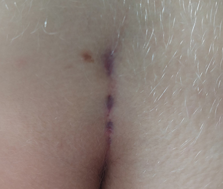 Nahaufnahme einer verheiltenden Narbe nach der Behandlung eines Analabszesses.