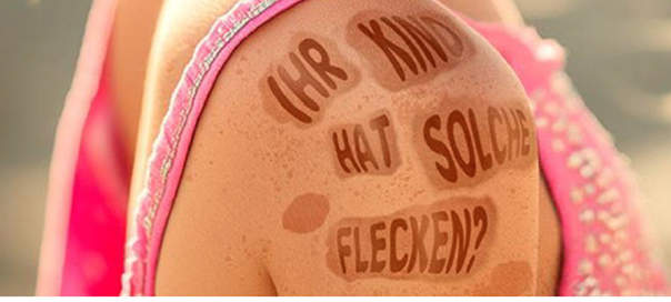 Haut mit Café-au-lait-Flecken und der Frage „Ihr Kind hat solche Flecken?“ als Hinweis auf Neurofibromatose Typ 1.