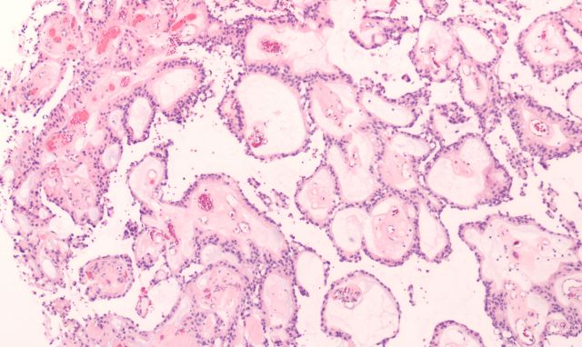 Mikroskopische Aufnahme eines Glioms mit immunsuppressivem Tumormikromilieu.