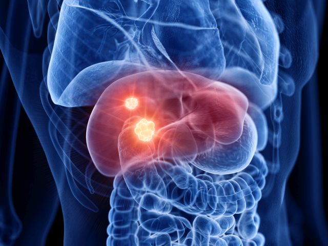 Medizinische Darstellung einer Leber mit hervorgehobenen Tumoren, passend zur Erstlinientherapie des hepatozellulären Karzinoms (HCC) mit Nivolumab und Ipilimumab.