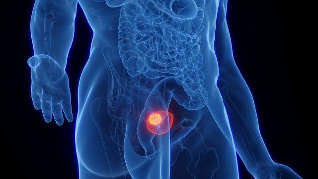 Visualisierung eines Tumors in der Blase, dargestellt in einem menschlichen Körpermodell.