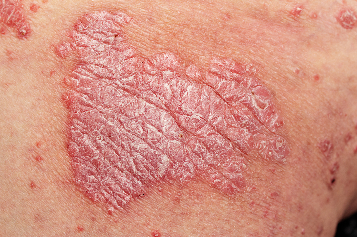 Nahaufnahme von Haut mit Psoriasis, die durch rote, schuppige Stellen gekennzeichnet ist.