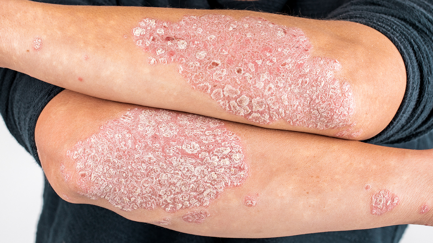 Nahaufnahme von Armen mit Psoriasis (Schuppenflechte), die rote und schuppige Hautstellen zeigen.