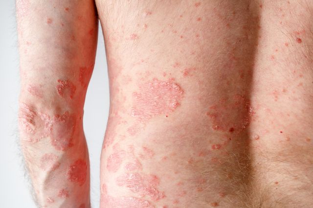 Nahaufnahme von Hautläsionen bei Psoriasis (Schuppenflechte) am Rücken eines Erwachsenen.