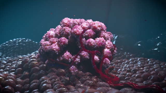 Künstlerische Darstellung eines soliden Tumors mit vaskulären Strukturen, thematisch passend zur klonalen Hämatopoese (CHIP).