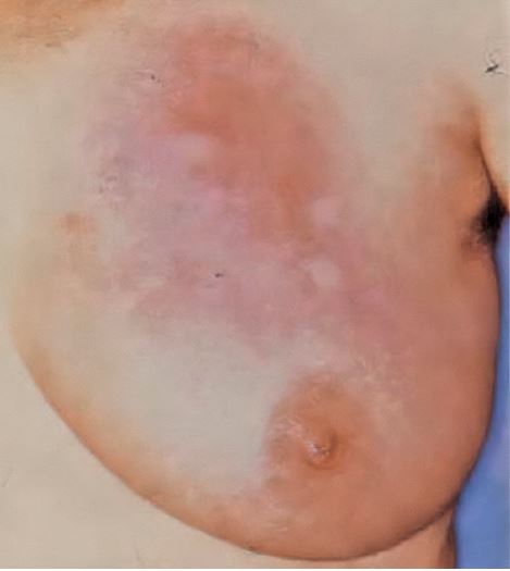 Abb. 1: Idiopathische granulomatöse
Mastitis. Klinischer Befund der linken
Brust mit multizentrischer, quadrantenübergreifender,
teils konfluierender
Hautrötung, kombiniert mit multiplen
kutanen Indurationen über intramammärer
Knotenbildung.