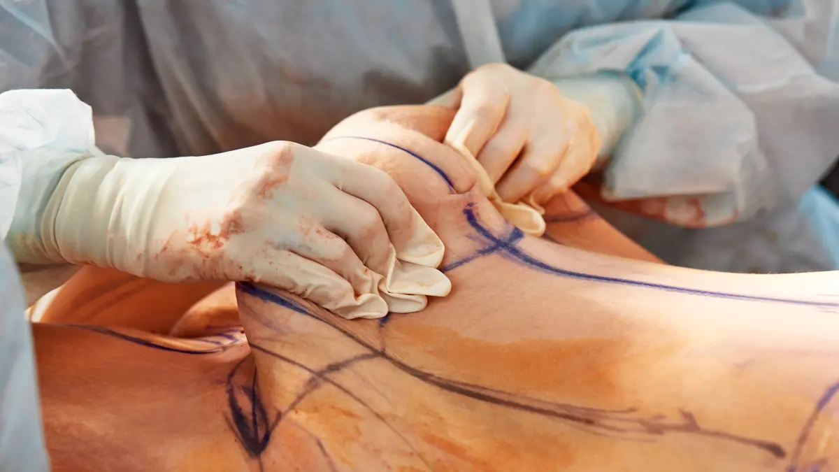 Es wird ein Bauch mit überschüssiger Haut und mit markieren Linien gezeigt.