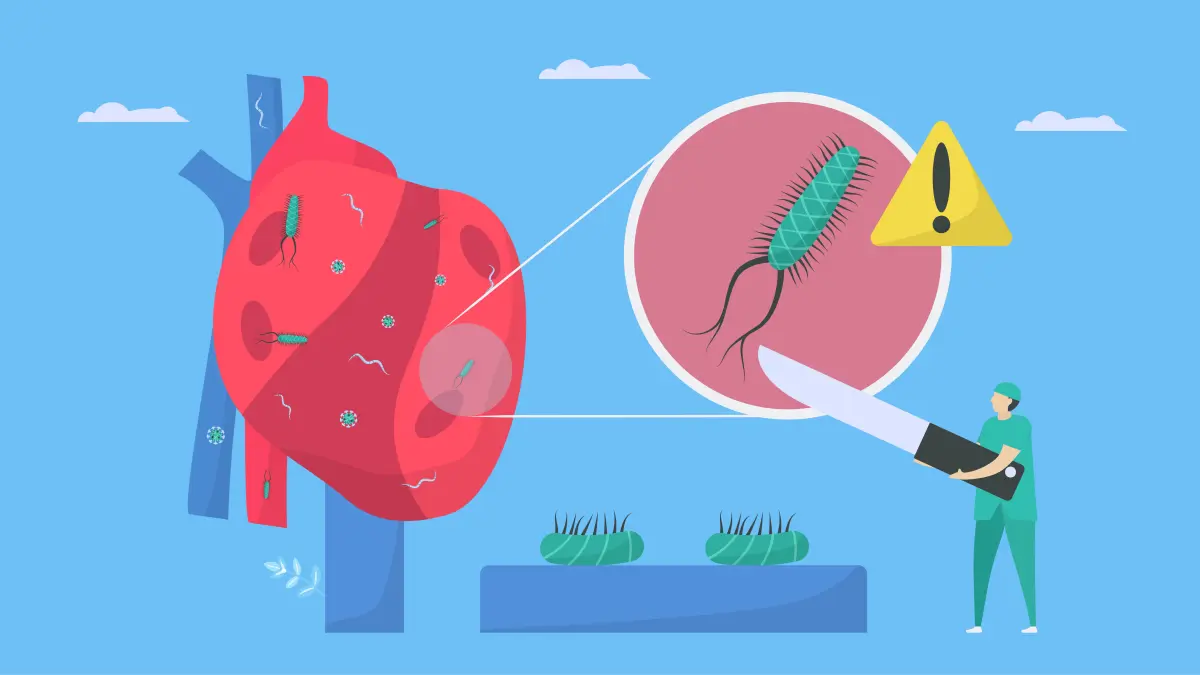 Illustrative Darstellung eines Herzens mit Endokarditis, Viren, Pilze und Bakterien bewegen sich zu den Blutgefäßen, daneben ein Chirurg mit Messer.