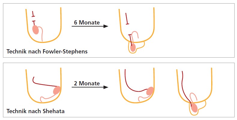 Abb. 2: Schematische Darstellung der beiden laparoskopischen Verfahren; rot: Samenstranggefäße, rosa: Ductus deferens